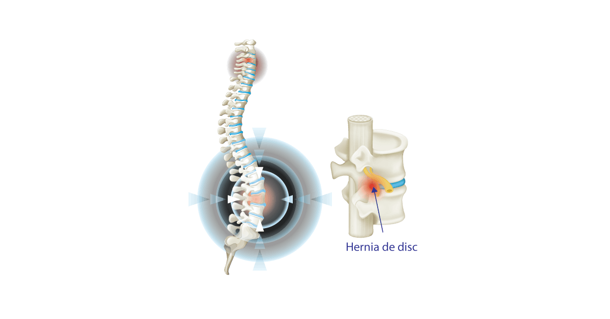 Hernia de disc - cauze, simptome, tratament, preventie